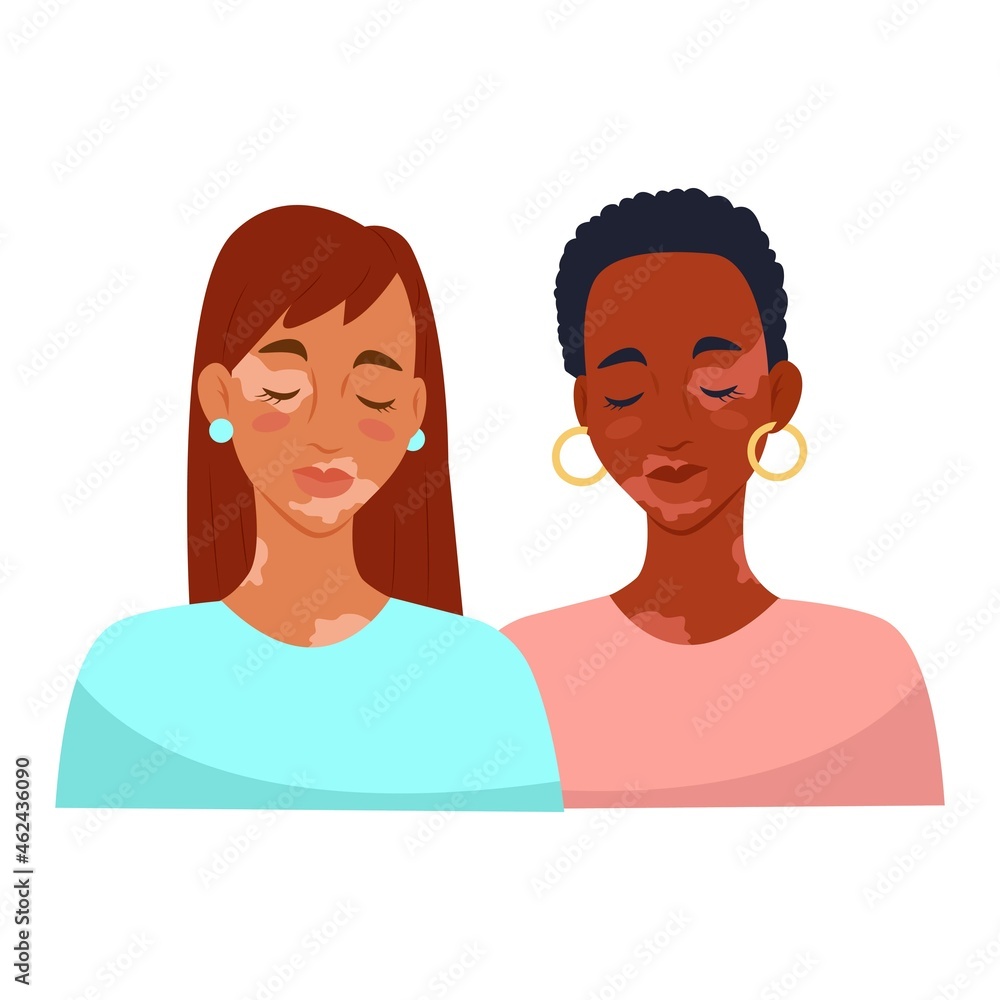 Two women with vitiligo. Vitiligo skin disease. Vector illustration. Two women with vitiligo. Vitiligo skin disease. Vector illustration.