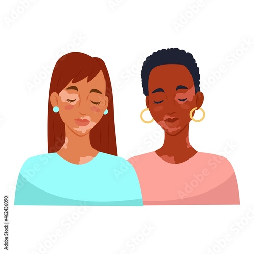 Two women with vitiligo. Vitiligo skin disease. Vector illustration.
