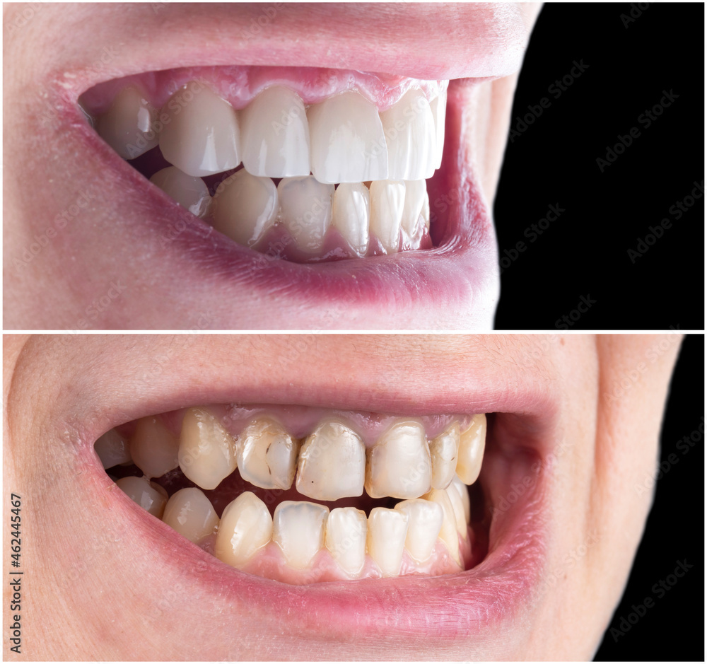 Fototapeta premium teeth treatment before and after picture