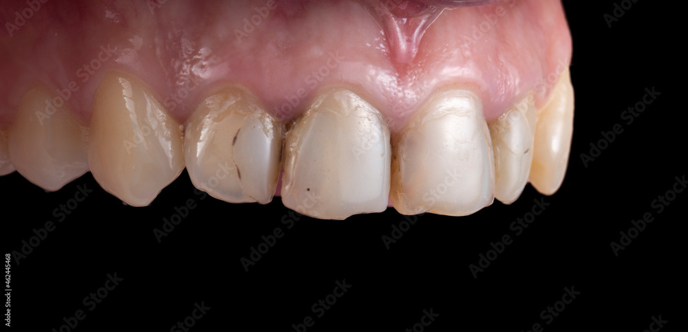Fototapeta premium natural teeth with cavities before starting dental treatment