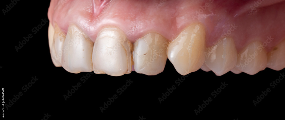 Fototapeta premium natural teeth with cavities before starting dental treatment