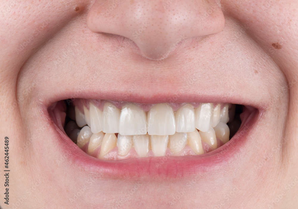 Fototapeta premium press ceramic crowns and veneers