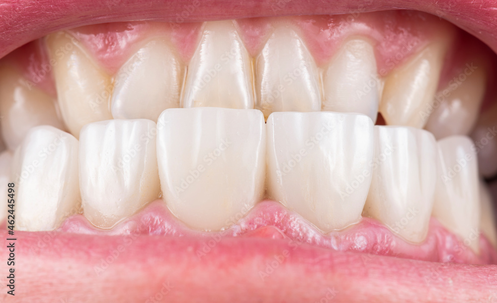 press ceramic crowns and veneers press ceramic crowns and veneers
