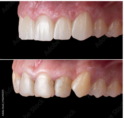 teeth treatment before and after picture