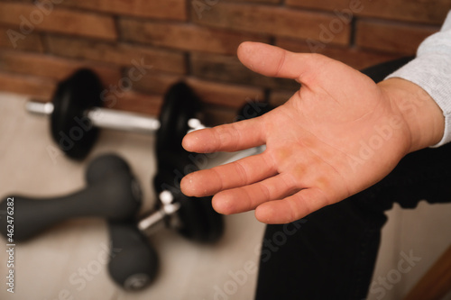 Man suffering from calluses on hand indoors  closeup