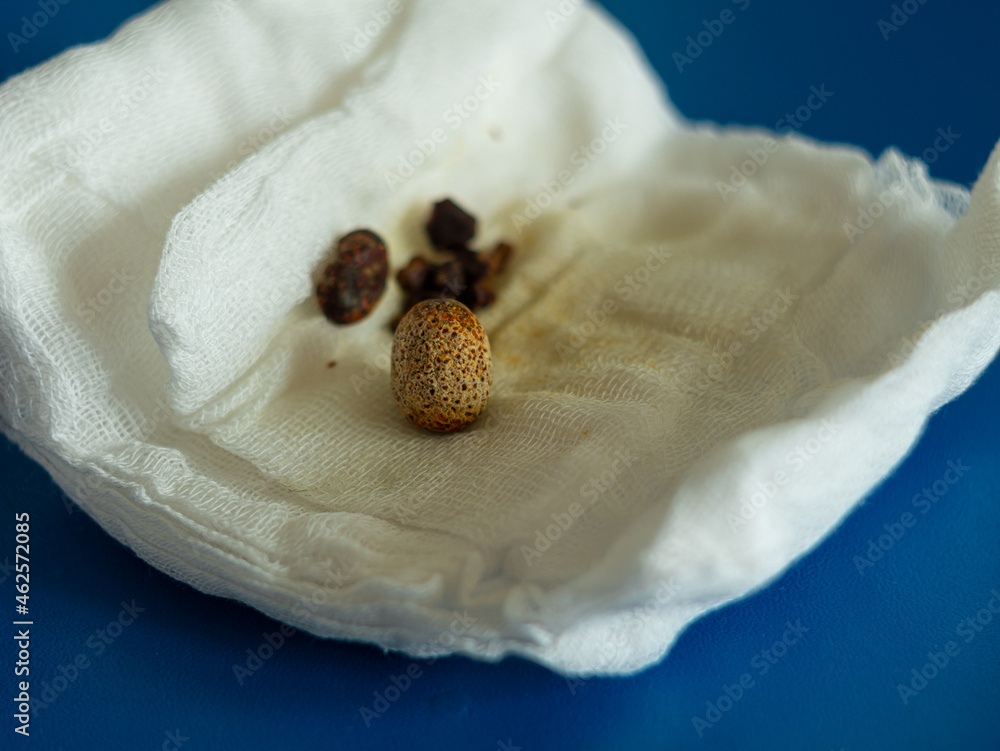 Removed gallstones on compress after gallbladder laparoscopic surgery