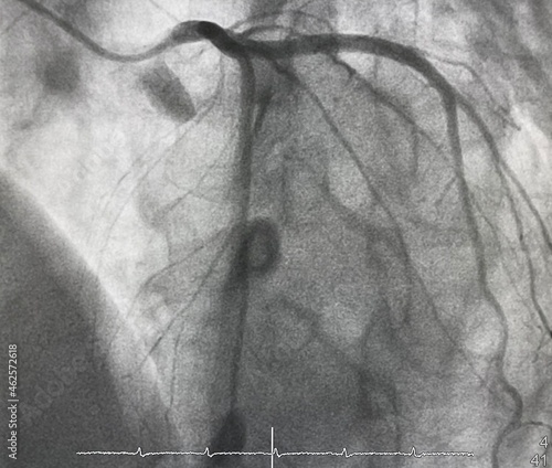 Принти на полотні Normal left coronary artery (LCA) angiography.