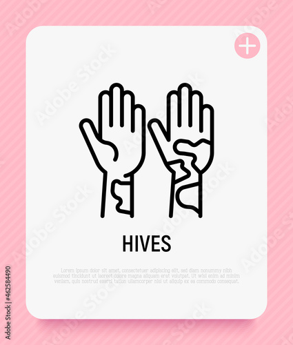 Hives on hand thin line icon. Allergy symptom. Modern vector illustration of allergic reaction.