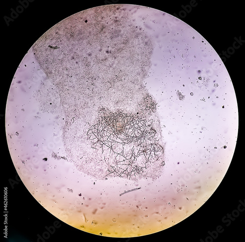 Microscopic view of dermatophytes, skin scraping for fungus test photo