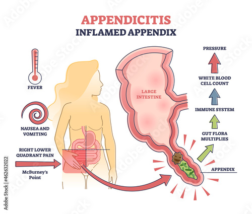 Appendicitis, inflamed appendix, abdominal medical problem diagnosis outline diagram. Acute pain in lower right quadrant called McBurneys point. Process in the large intestine producing pressure.