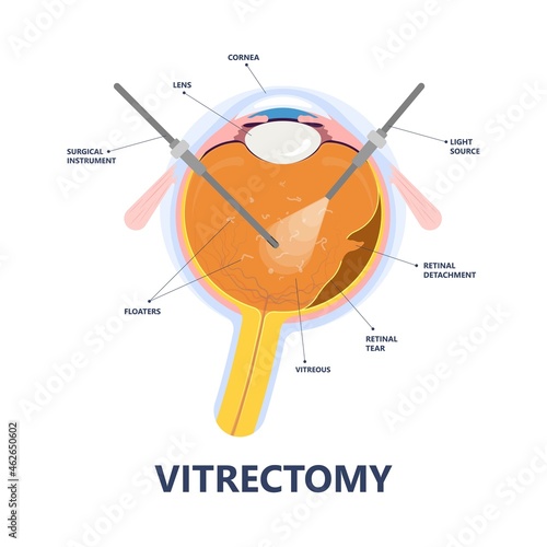 Eye floaters fluid vision retina myopia trauma surgery loss of light tear torn laser surgical repair older Detached blurry shadow Pain injury hole macular Age treat blood dark lose wear Pars Plana