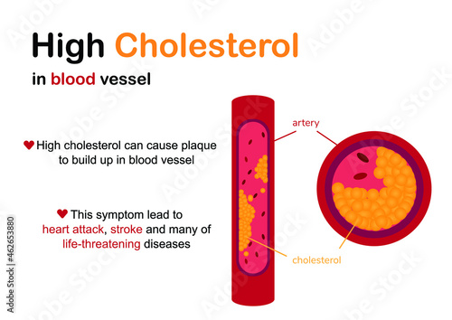 Diagram shows high cholesterol in blood vessel