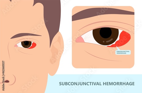 Subconjunctival hemorrhage blood vessel eye broken small rupture Violent coughing Powerful sneezing Straining injury High pressure red spot white pink stroke virus LASIK