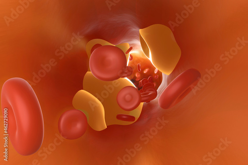 Three dimensional render of artery clogged by cholesterol photo