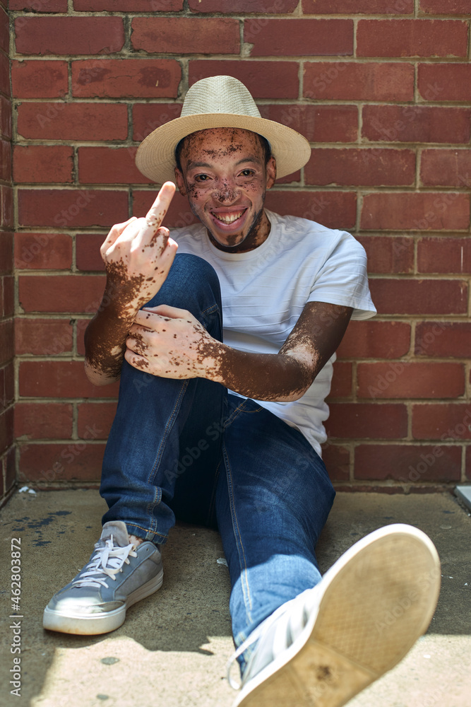 © victor espadas/Westend61 - Portrait of young man with vitiligo wearing a hat, giving the finger © victor espadas/Westend61 - Portrait of young man with vitiligo wearing a hat, giving the finger