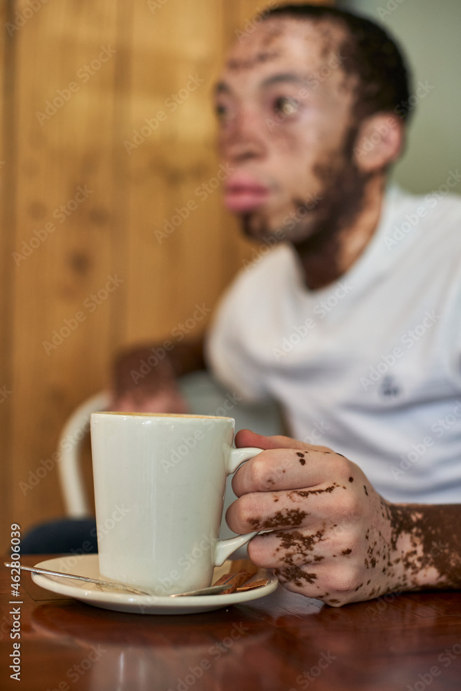 Young man with vitiligo sitting in a cafeteria and holding a coffee mug Young man with vitiligo sitting in a cafeteria and holding a coffee mug