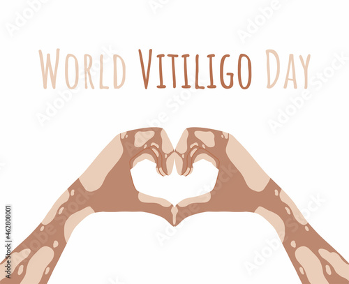 Hands with vitiligo disease. Support for people with skin pigmentation disorders. Heart, self-love and body positive. Light skin, mutalka. Body positive. Hand drawn illustration. Vector