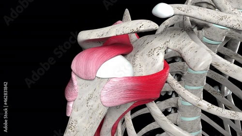 Shoulder Injury with Small Crescent Tear of the Rotator Cuff