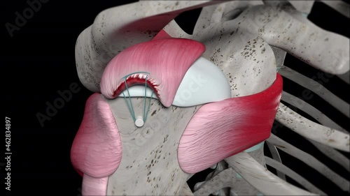 Shoulder Surgery With One Anchor Suture for the Rotator Cuff Tear photo