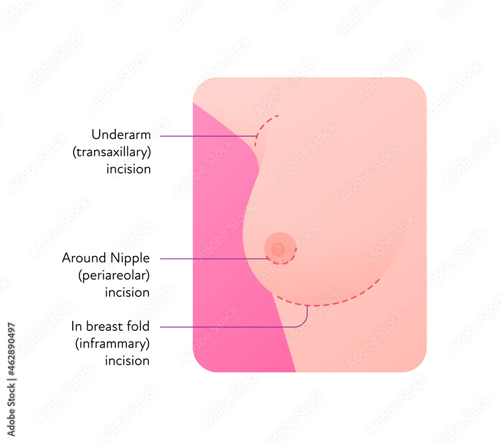 Female breast surgery infographic chart. Vector flat medical illustration.  Underarm transaxillary, periareolar, inframmary incision types. Design for  beauty healthcare industry. Stock Vector