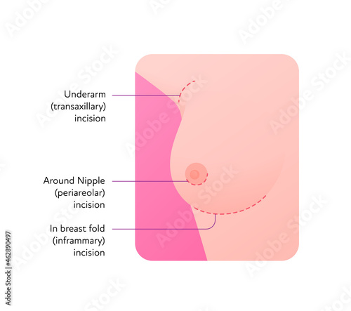 Female breast surgery infographic chart. Vector flat medical illustration. Underarm transaxillary, periareolar, inframmary incision types. Design for beauty healthcare industry.