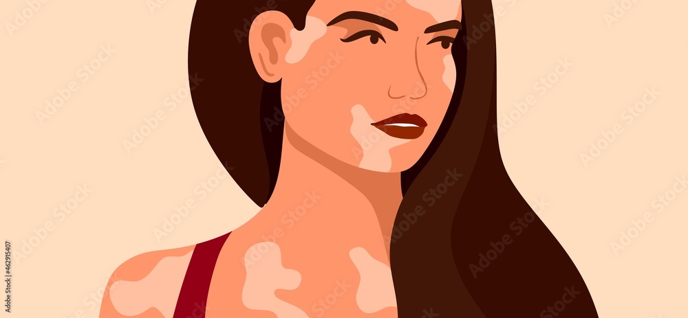Vitiligo is a young woman with skin problems. Skin diseases. The concept of World Vitiligo Day. Different skin colors of female characters. For a blog, articles, banner, magazine. Vitiligo is a young woman with skin problems. Skin diseases. The concept of World Vitiligo Day. Different skin colors of female characters. For a blog, articles, banner, magazine.