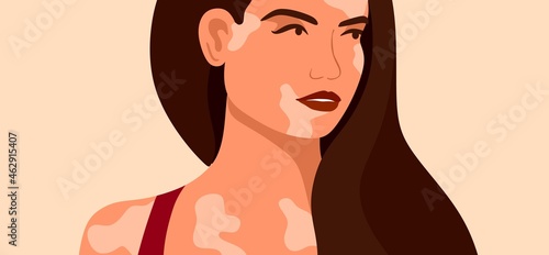 Vitiligo is a young woman with skin problems. Skin diseases. The concept of World Vitiligo Day. Different skin colors of female characters. For a blog, articles, banner, magazine.