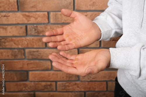 Man suffering from calluses on hands near brick wall, closeup