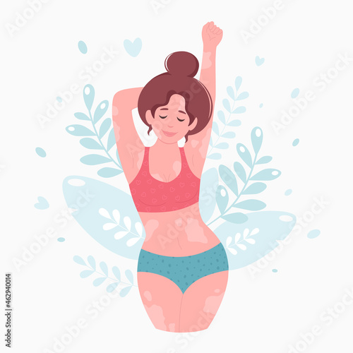 Woman with vitiligo. World vitiligo day. Self care  self love  body positive. Vector illustration