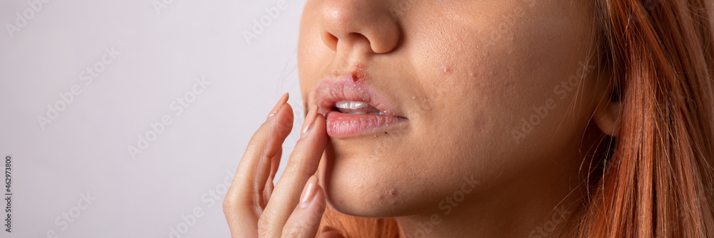 Beautiful woman with herpes. Herpes on the lips of a young woman. Beautiful woman with herpes. Herpes on the lips of a young woman.
