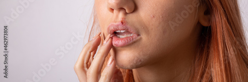 Tableau sur toile Beautiful woman with herpes. Herpes on the lips of a young woman.