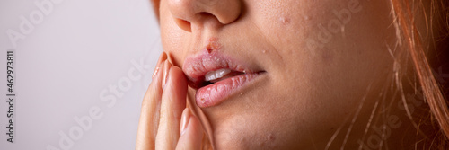 Beautiful woman with herpes. Herpes on the lips of a young woman.