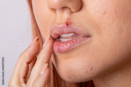 Beautiful woman with herpes. Herpes on the lips of a young woman.