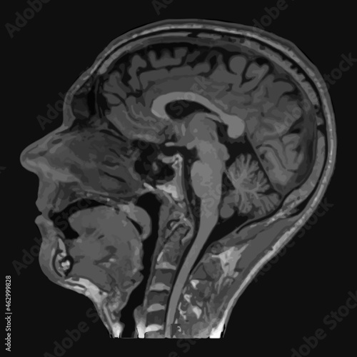 Realistic image sagittal of male head with CT scan, MRI Magnetic resonance imaging layer of head. Isolated on dark background. Vector illustration. photo