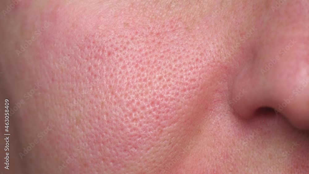 Macro enlarged pores. Problematic skin. Irritation on the face. Cosmetology. Macro enlarged pores. Problematic skin. Irritation on the face. Cosmetology.