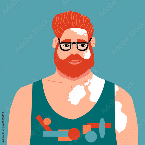 Red-haired man in glasses and a T-shirt with Vitiligo. Skin pigmentation problems. Taking care of your health. Vector illustration