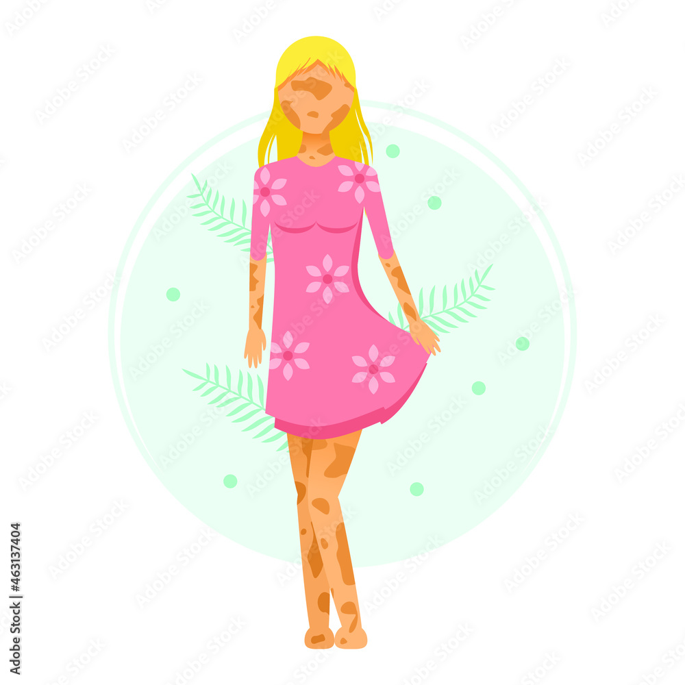 Flat Girl Woman Character In Dress Vitiligo Depigmentation Disease Vector Design Style Concept People Are Equal Flat Girl Woman Character In Dress Vitiligo Depigmentation Disease Vector Design Style Concept People Are Equal