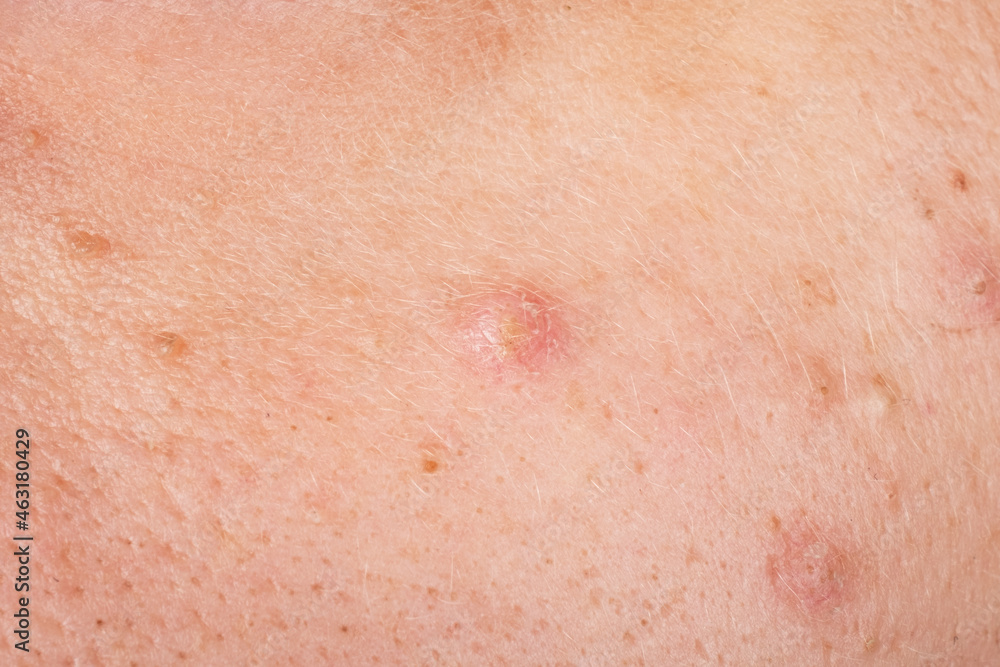 acne on the face close up, skin problems.. acne on the face close up, skin problems..