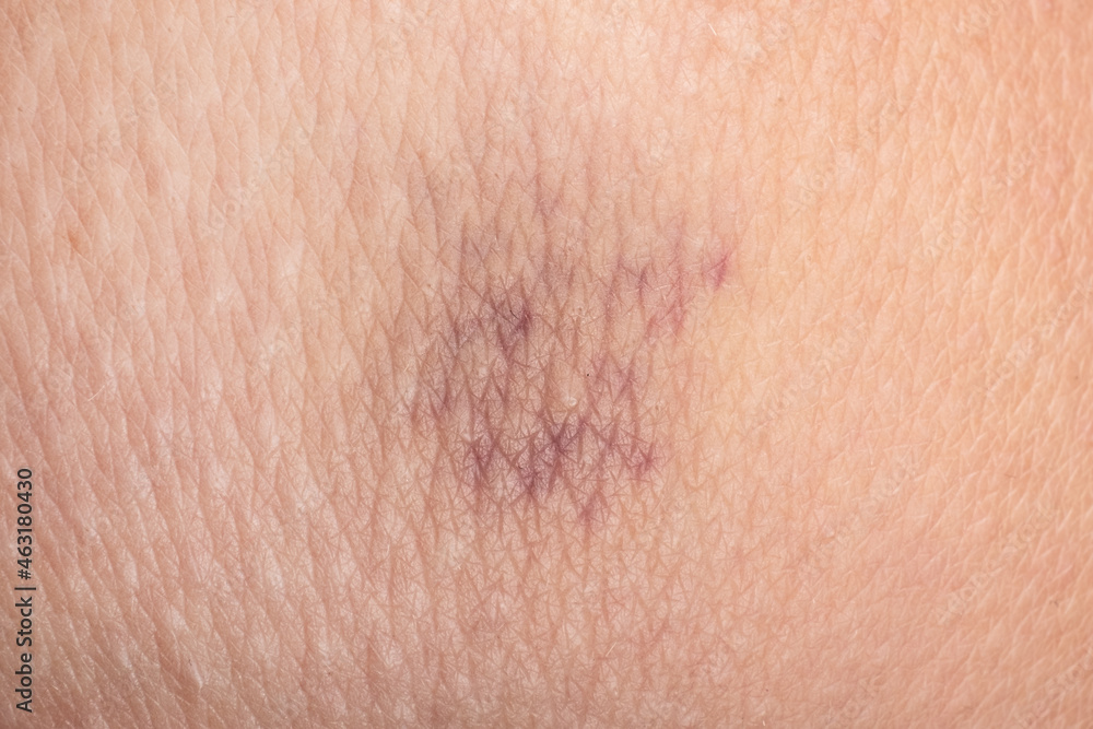 bruise on the skin close up, capillaries on damaged skin bruise on the skin close up, capillaries on damaged skin