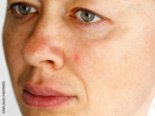 Cuperosis on the cheek of middle aged woman. Rosacea acne on the face. Erythrosis rosacea