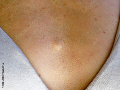 sebacous hyperplasia of the woman's chest. Atheroma or lipoma photo
