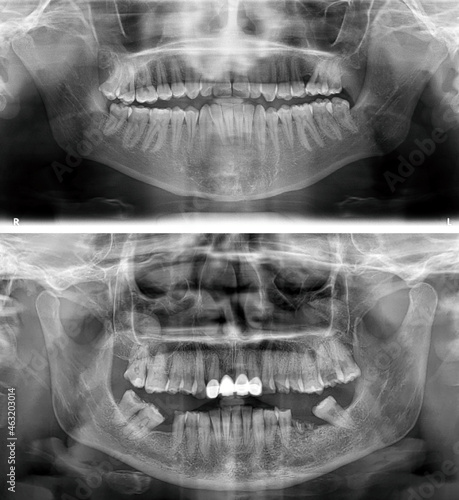 Comparison between a panoramic x-ray image of teeth of an healthy teeth and a bad healthy teeth.