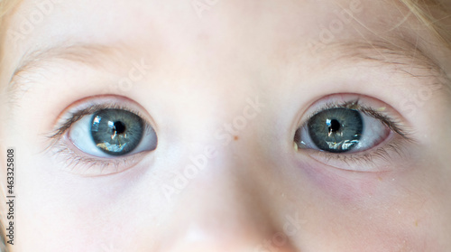 Eye of a child with conjunctivitis. Infected eye. Red eyes. Pus in the eye. 