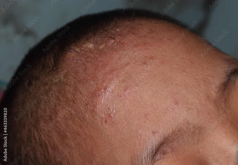 Small skin lesions on forehead Small skin lesions on forehead