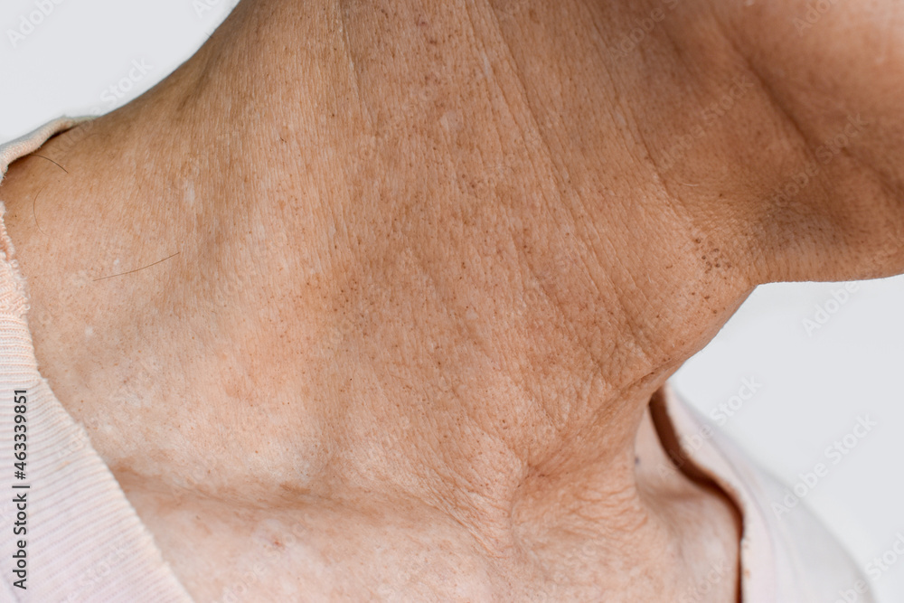 Aging skin folds or skin creases or wrinkles at neck Aging skin folds or skin creases or wrinkles at neck