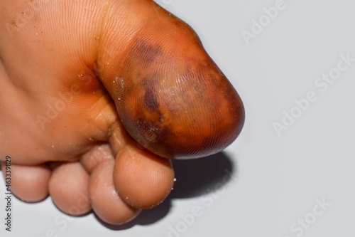 Abscess and cellulitis or Staphylococcal, Streptococcal skin infection at the big toe of Asian male patient. photo