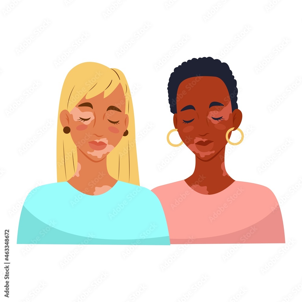 Two women with vitiligo. Vitiligo skin disease. Vector illustration. Two women with vitiligo. Vitiligo skin disease. Vector illustration.