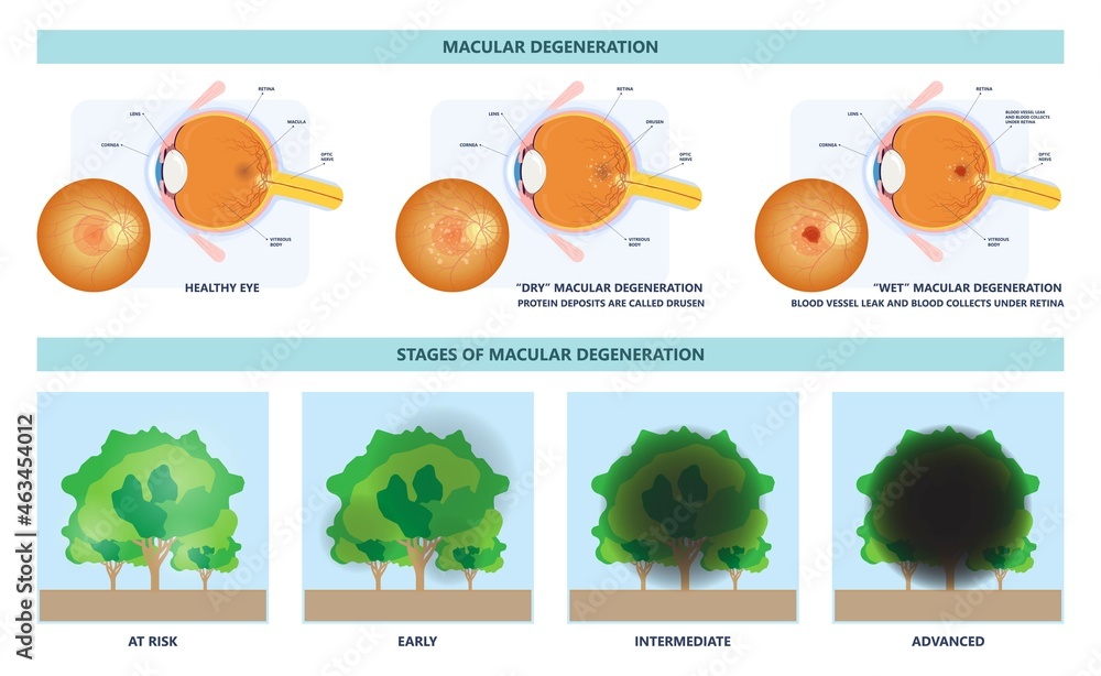 macular degeneration hemorrhage dry wet Age hole pucker edema eye