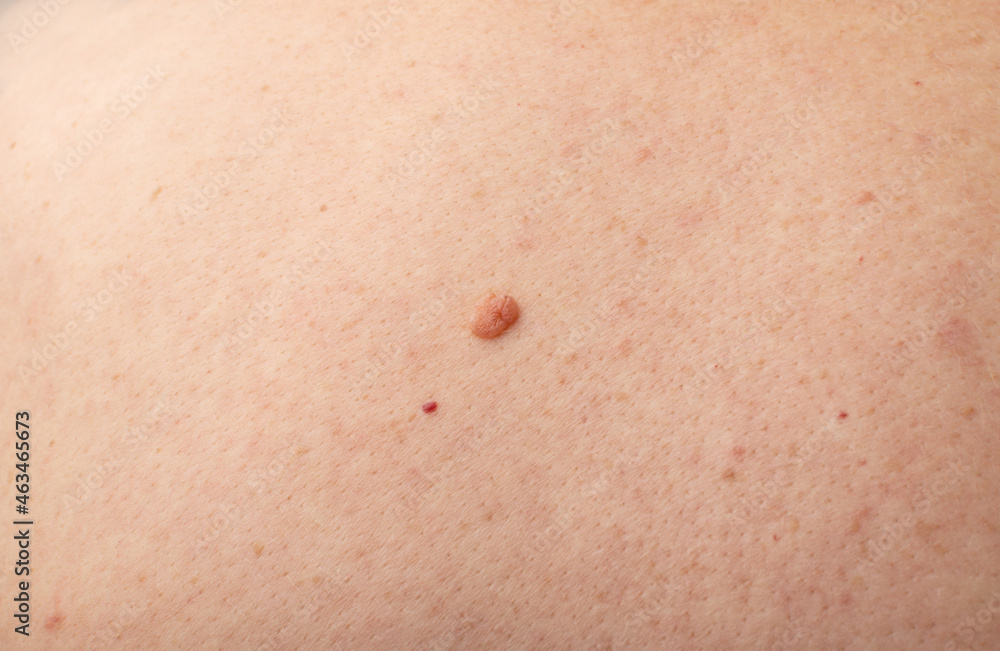 Fototapeta premium Skin mole closeup. Macro photo of blemish similar to melanoma