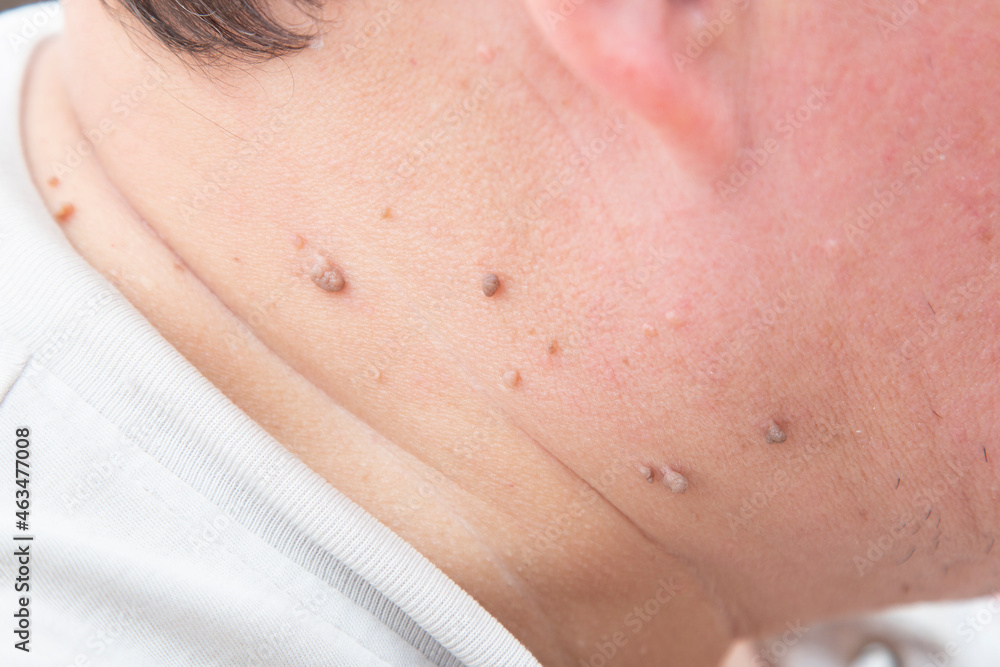 Fototapeta premium Papillomas on a person's neck.Human skin disease.